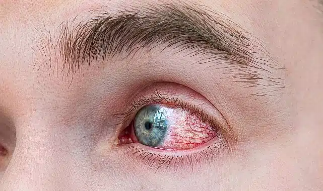 Bahar Alerjisinde Göz Ovalamak Körlüğe Yol Açıyor